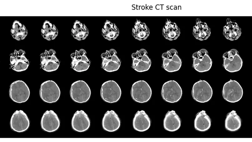 Brain stroke detection from CT scans via 3D Convolutional Neural Network
